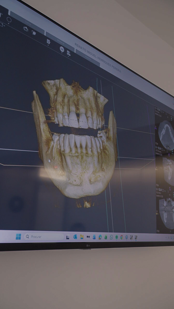 TAC 3D — planeamento de implantes