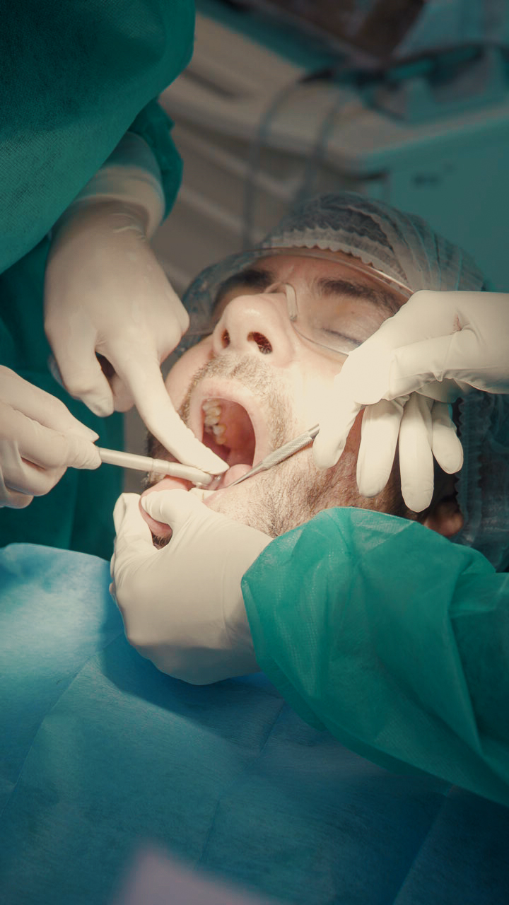 Implantes Dentários