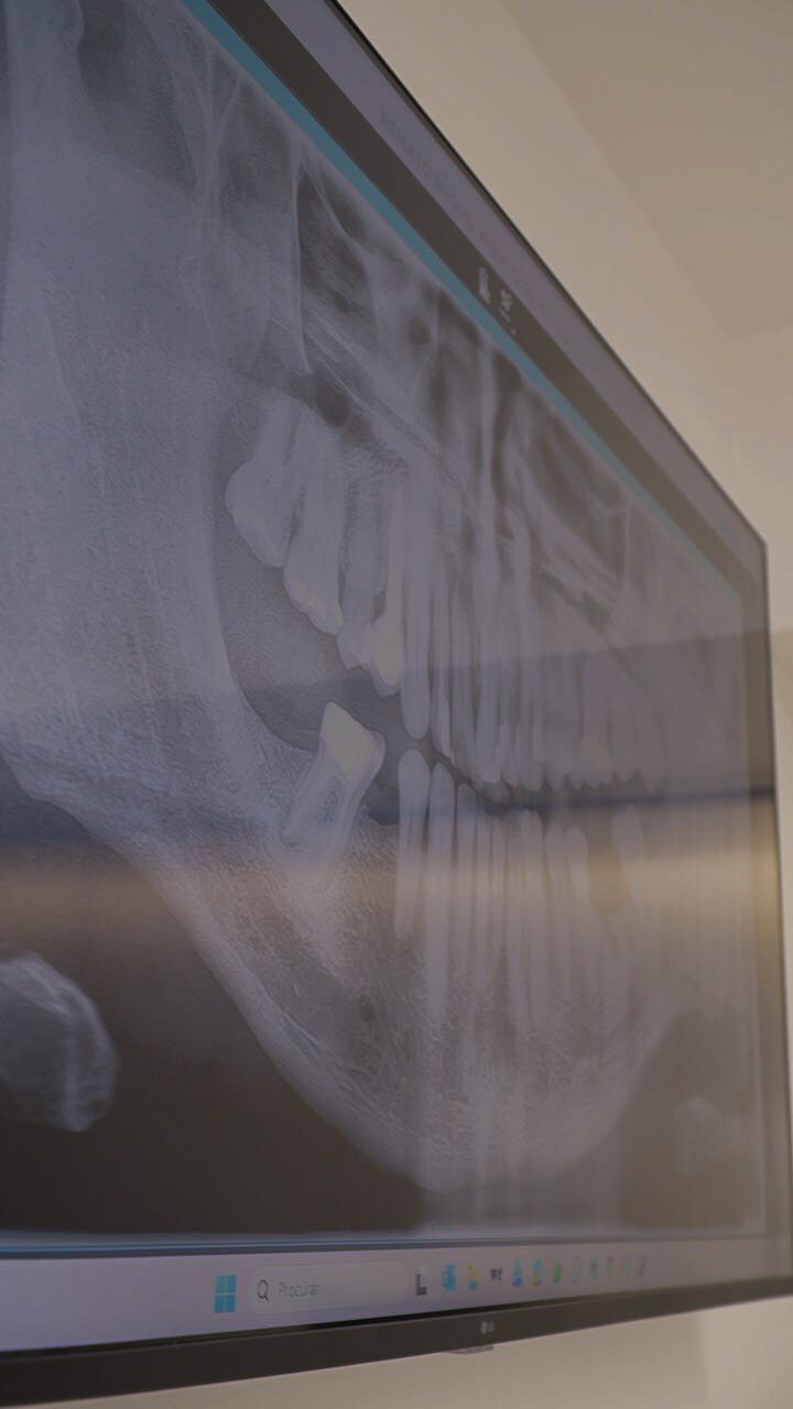 Radiografia para planeamento de implante dentário